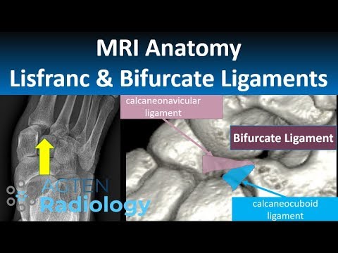 Anatomía de Ligamentos de Lisfranc y Bifurcados en Tobillo y Pie: MRI y Lesiones Traumáticas